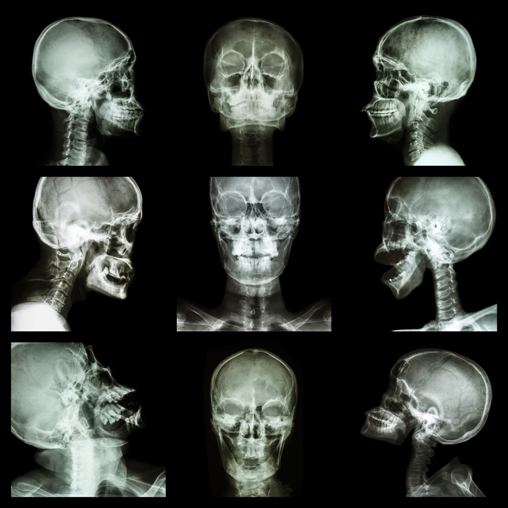 人体头部x光片